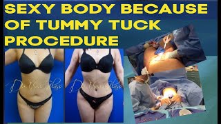 Square Shaped Body No More After Tummy Tuck Procedure | Dr.Cortes, Plastic Surgeon in Houston TX