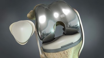Total Knee Replacement (3D Animation)