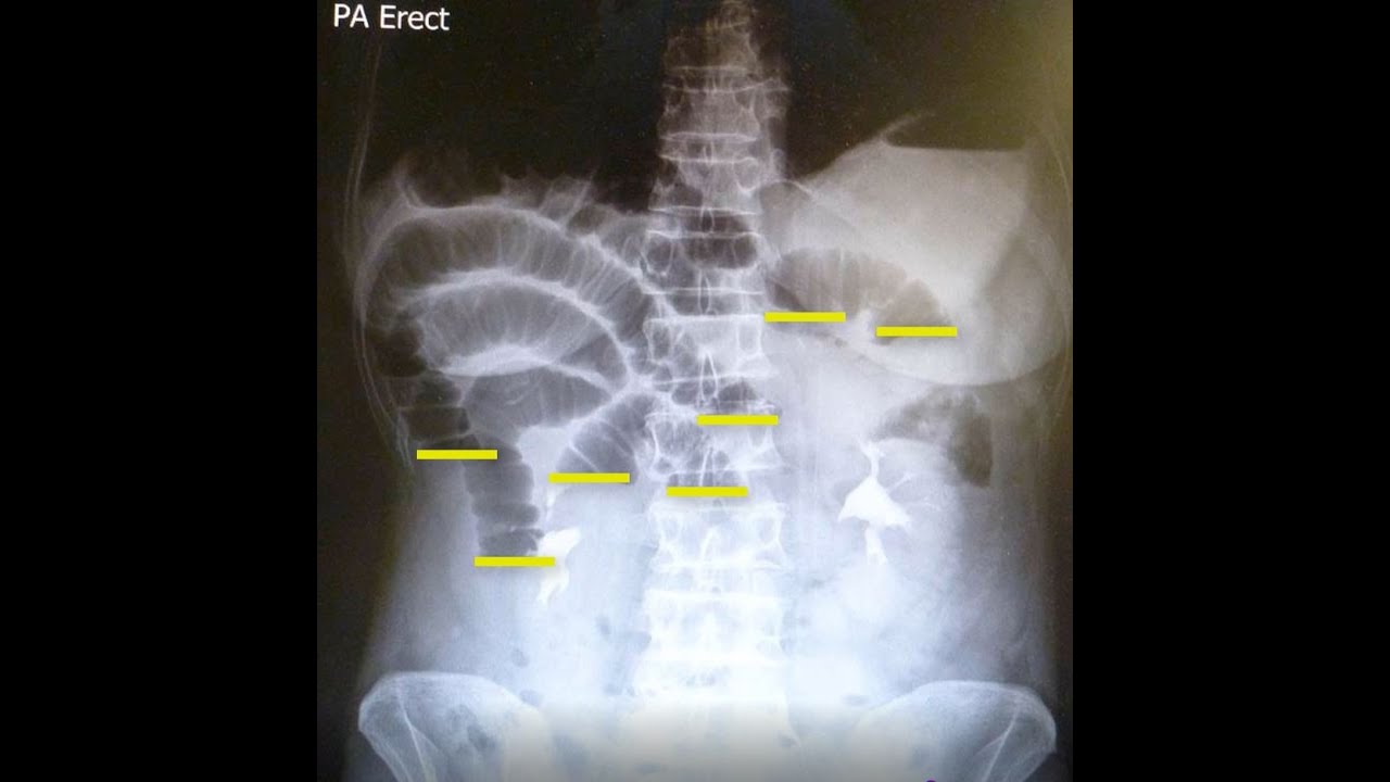 Small bowel obstruction in 1 coffee. YouTube