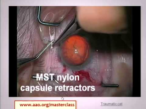 A Case of an IOL Exchange