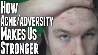 How Acne/Adversity Makes Us Stronger