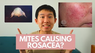 MANAGEMENT OF ROSACEA