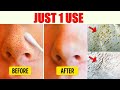 Fastest way to Remove Blackheads from Nose &amp; Face! JUST 1 USE Will Clear Your Blackheads Away