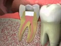 Dentist - Root Canal Retreatment