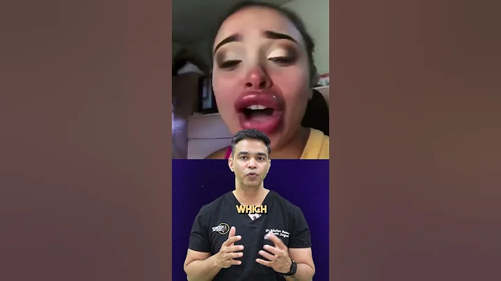 Lip filler gone wrong. #shorts