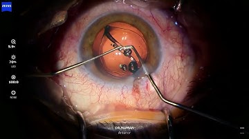 Optima® VUE Intraocular Lens, Dr.Numan KÜÇÜK