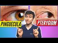 Pinguecula Vs Pterygium (Signs, Symptoms, Treatment)