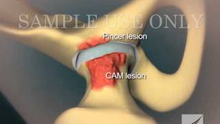 Femoroacetabular Impingement in the Hip