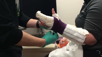 Radial gutter waterproof cast