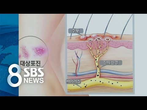   대상포진 젊은 환자 늘어난 이유 SBS