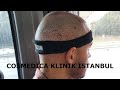 Operation istanbul  14 tage update  cosmedica hair transplantation clinic  dr levent acar