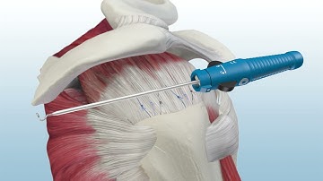 MEDHOLD  single row rotator cuff augmentation using genesys crossft allopatch hd and poplok