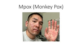 Mpox (Monkey Pox) by House Job 18 views 1 month ago 8 minutes, 28 seconds