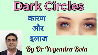 Dark Circles Around Eyes - Causes Treatment-- By Dr Yogendra Bola