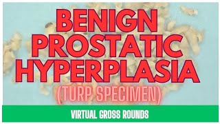 Gross Anatomy of Prostate: TURP for BPH - Pathology Education