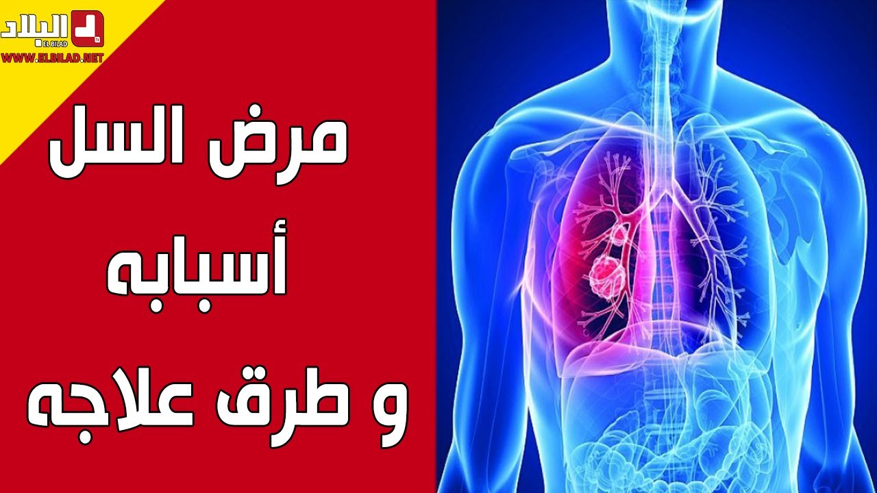 مرض السل.. أسبابه و طرق علاجه