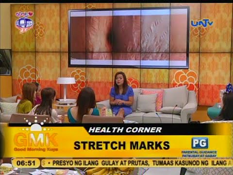 Video: Paano makitungo sa mga stretch mark sa panahon ng pagbubuntis