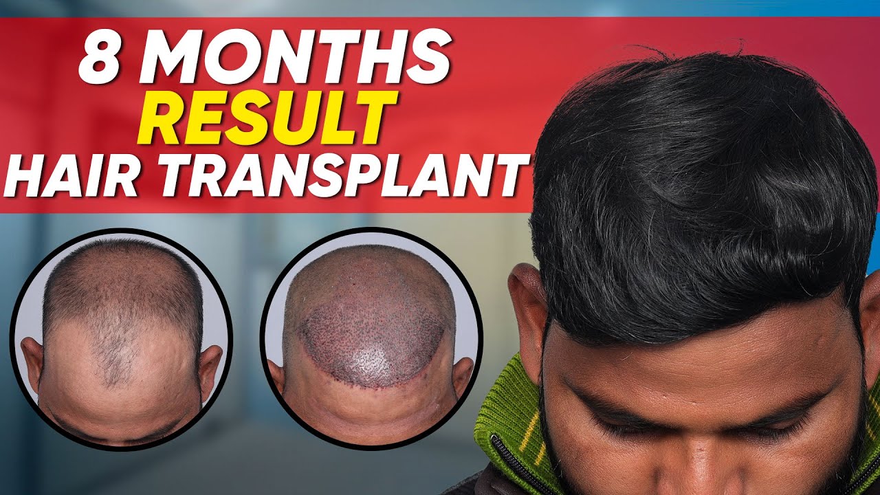Hair Transplant in Kerala Best Results & Cost of Hair Transplant in Kerala YouTube