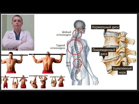 ВСЯ ПРАВДА | ТУРНИК И ГРЫЖА ДИСКА | Турник при Остеохондрозе