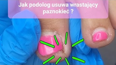 Jak podolog usuwa wrastające paznokcie? podologia #podopogotowie