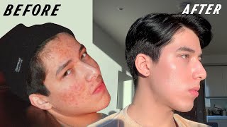 how i FINALLY cleared my acne: skincare, medication, diet? (scientific evidence)