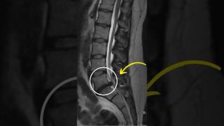 Lumbar disc Extrusion treatment at home sciatica backpain sciaticapainrelief mri fitfam