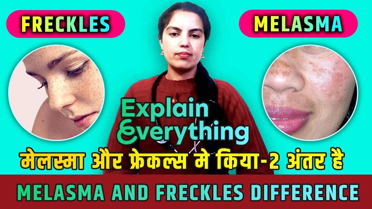 Melasma And Freckles Differences Melasmafreckleshyperpigmentation