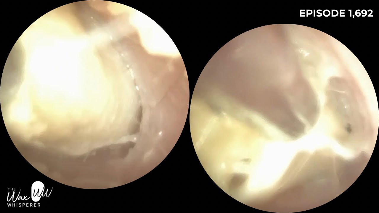 1,692 - Patient’s Ear Blocked Again Just 14 Days After Last Wax Removal