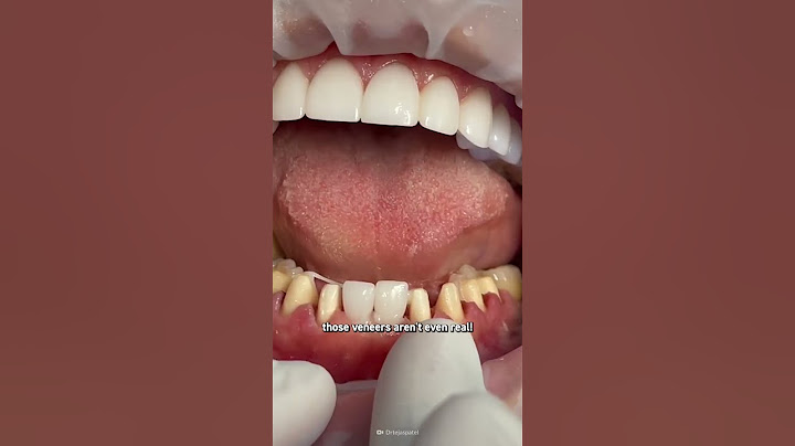 How to Survive the TikTok Veneer Trend #shorts