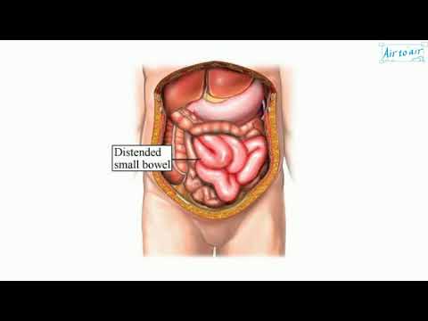 Video: Aceclidine - Lietošanas Instrukcijas, Cena, Analogi, Ziede, Pilieni