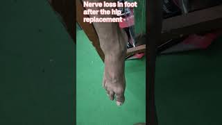 nerve loss in the foot after the hip replacement #physiotherapist #physiostudent #sportsphysio