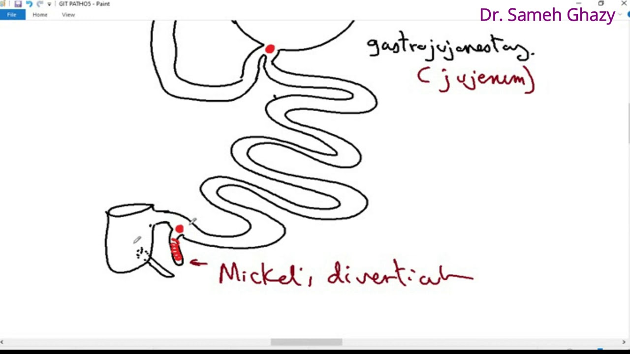 Systemic pathology 23 : GIT 4  ( peptic ulcer ) قرحة المعدة  DR.SAMEH GHAZY