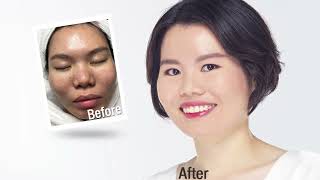 Customer Review - How New York Skin Solutions Ended Her 10 Year Battle with Acne in 6 months