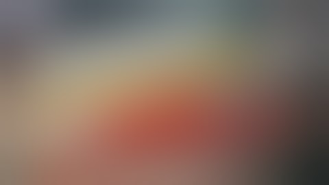 Commented 9: Fuchs heterochromic iridocyclitis Dr Sourabh Patwardhan