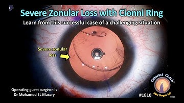 CataractCoach™1810: severe zonular loss with Cionni ring
