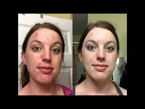 Neutrogena Oil-Free Acne Wash Cream Cleanser Micro Clear Review With Before and After