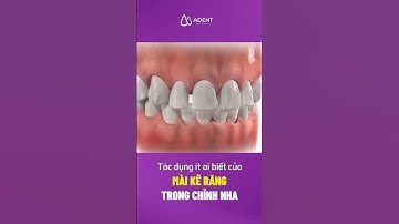Tác dụng ít ai biết của mài kẽ răng trong chỉnh nha