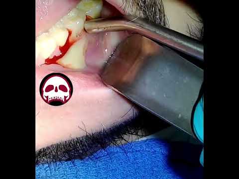 #abscess #abscesso #dentalabscess #inciseanddrain