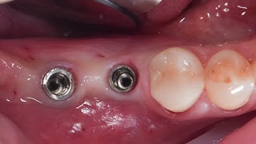 Soft tissue augmentation