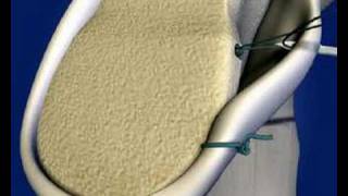 Shoulder Labral Repair