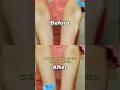 Vitiligo Treatment Case: Watch Her Skin Fully Recovered! #shorts