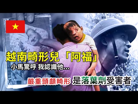 越南【嚴重頭顱畸形是落葉劑受害者...越南畸形兒「阿福」小馬驚呼我認識他！曾與台灣結善緣】│《經典好節目》世界第一等_精選版(回顧系列)