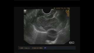 EUS-FNA in a patient with sarcoidosis