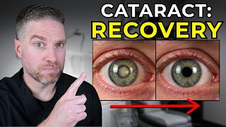 Cataract Surgery Recovery: What to Expect After Surgery!