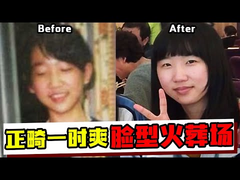 牙齿矫正失败给我带来了哪些后遗症？脸型崩坏*下颚骨错位*牙齿反弹