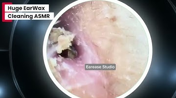Huge Earwax Blockage Removed - Must Watch! 👂🧼 | Deep ASMR Ear Cleaning Part 2