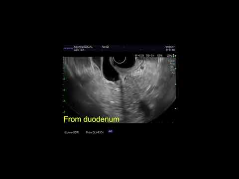 EUS of Pancreatic head cancer with CBD involvement by Dr. YT Kuo