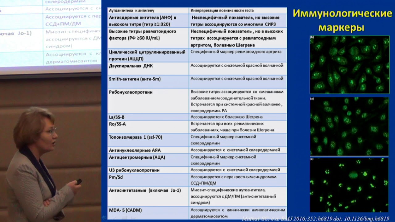 Маркеры заболеваний соединительной ткани. Поражения легких при системных заболеваниях соединительной ткани. Аутоантитела при системных заболеваниях соединительной ткани. Антисинтетазный синдром. Ревматоидный маркер