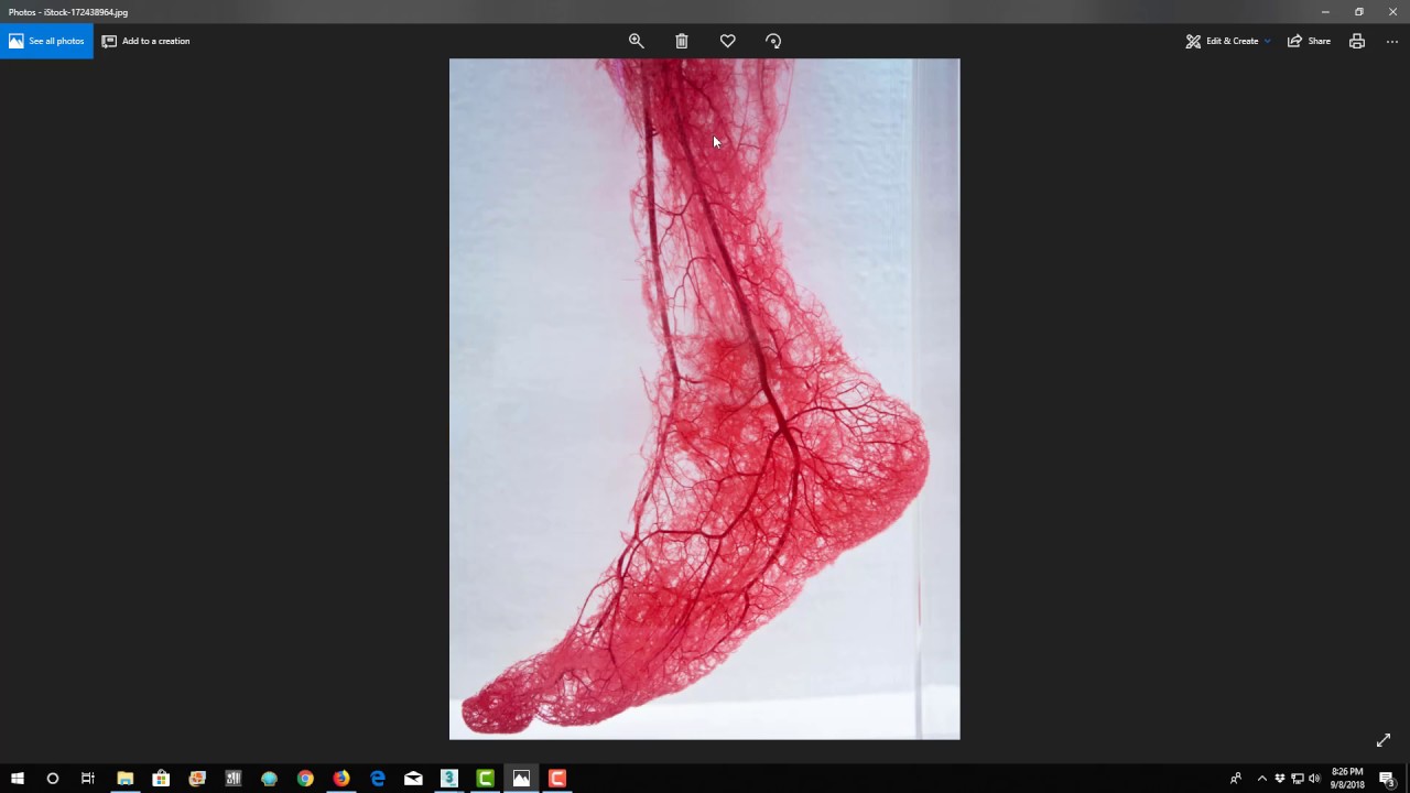 When Plantar Fasciitis doesn't respond right away with Erchonia's FX635 Laser Treatment