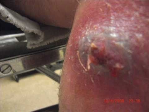 mrsa images of superbug skin infections youtube mercer illness